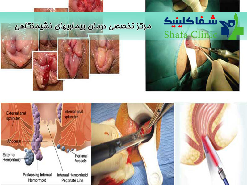 روش های تشخیص فیستول مقعدی