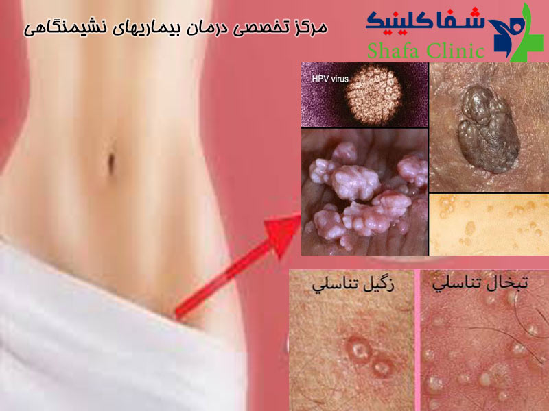 شایعترین علت سرطان گردن رحم در خانمها